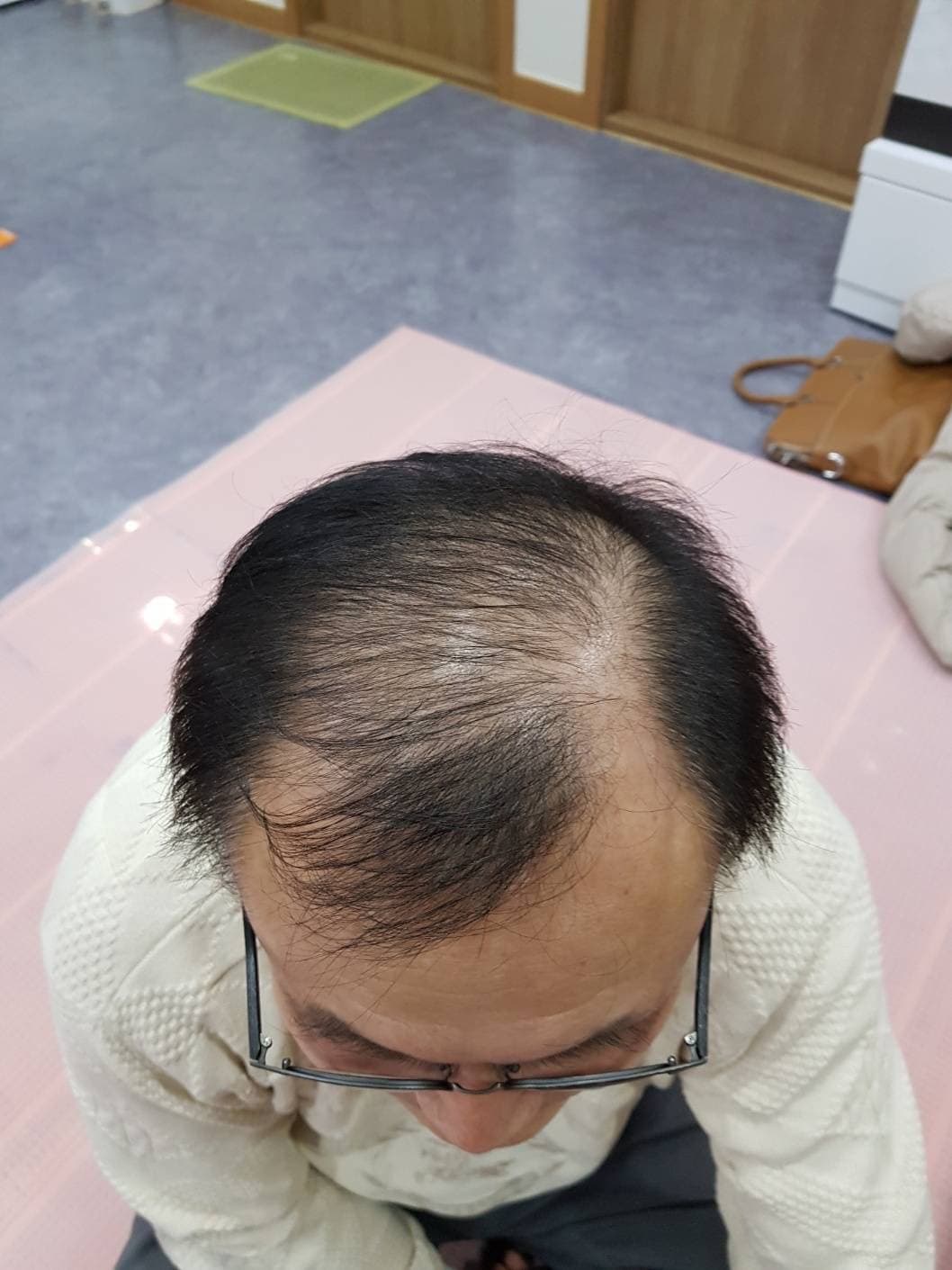 脱毛改善（男性） 施術前
