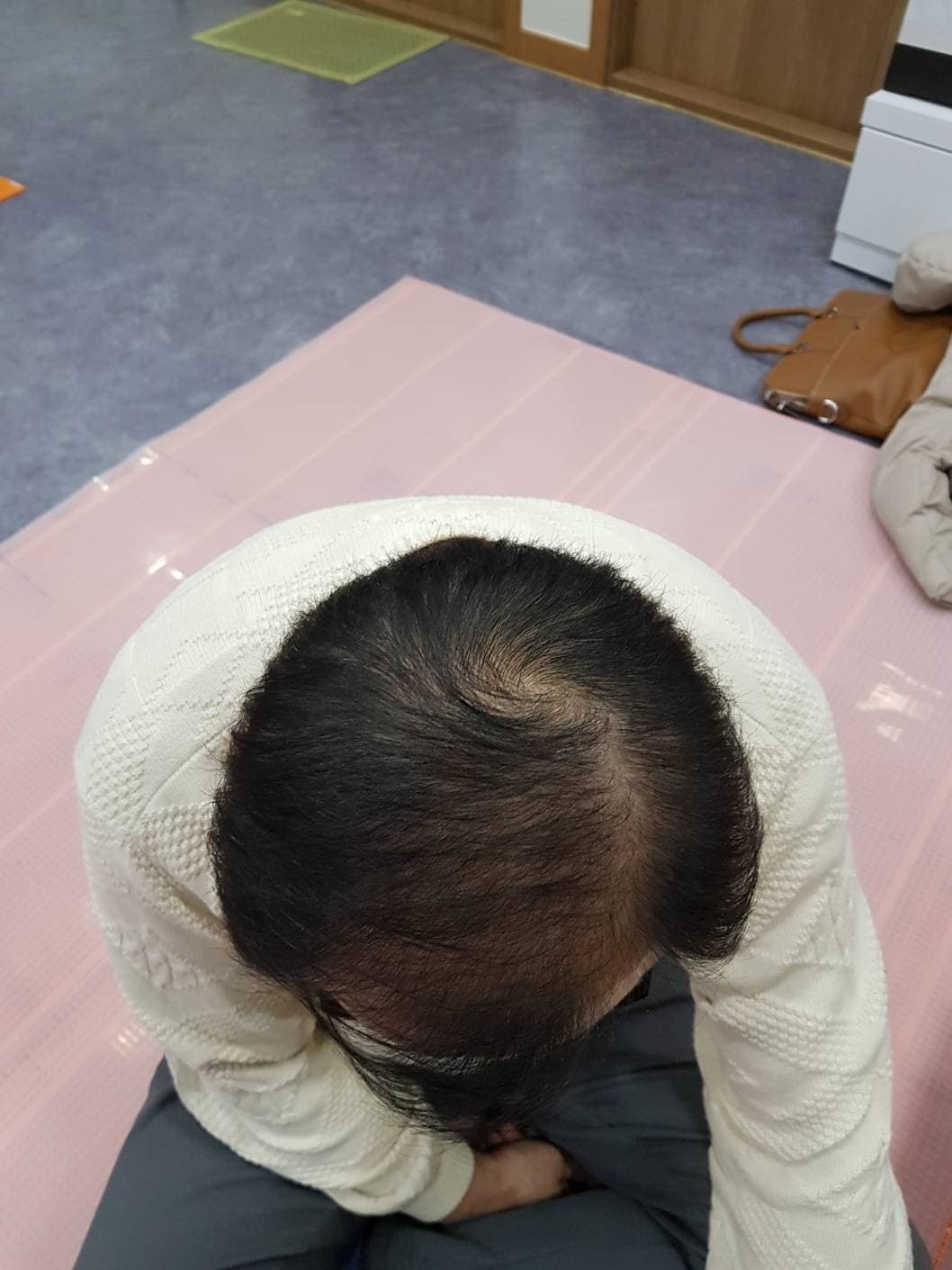 脱毛改善（男性） 施術後