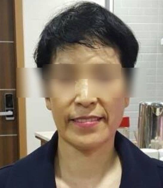 顔の皮膚改善 施術後