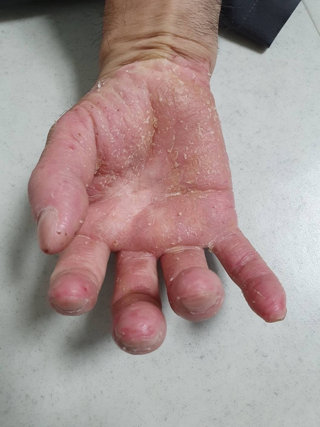 手の皮膚改善 施術前