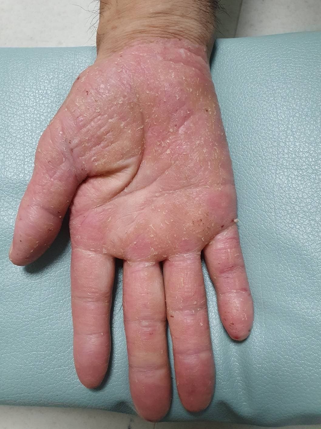 手の皮膚改善 施術後