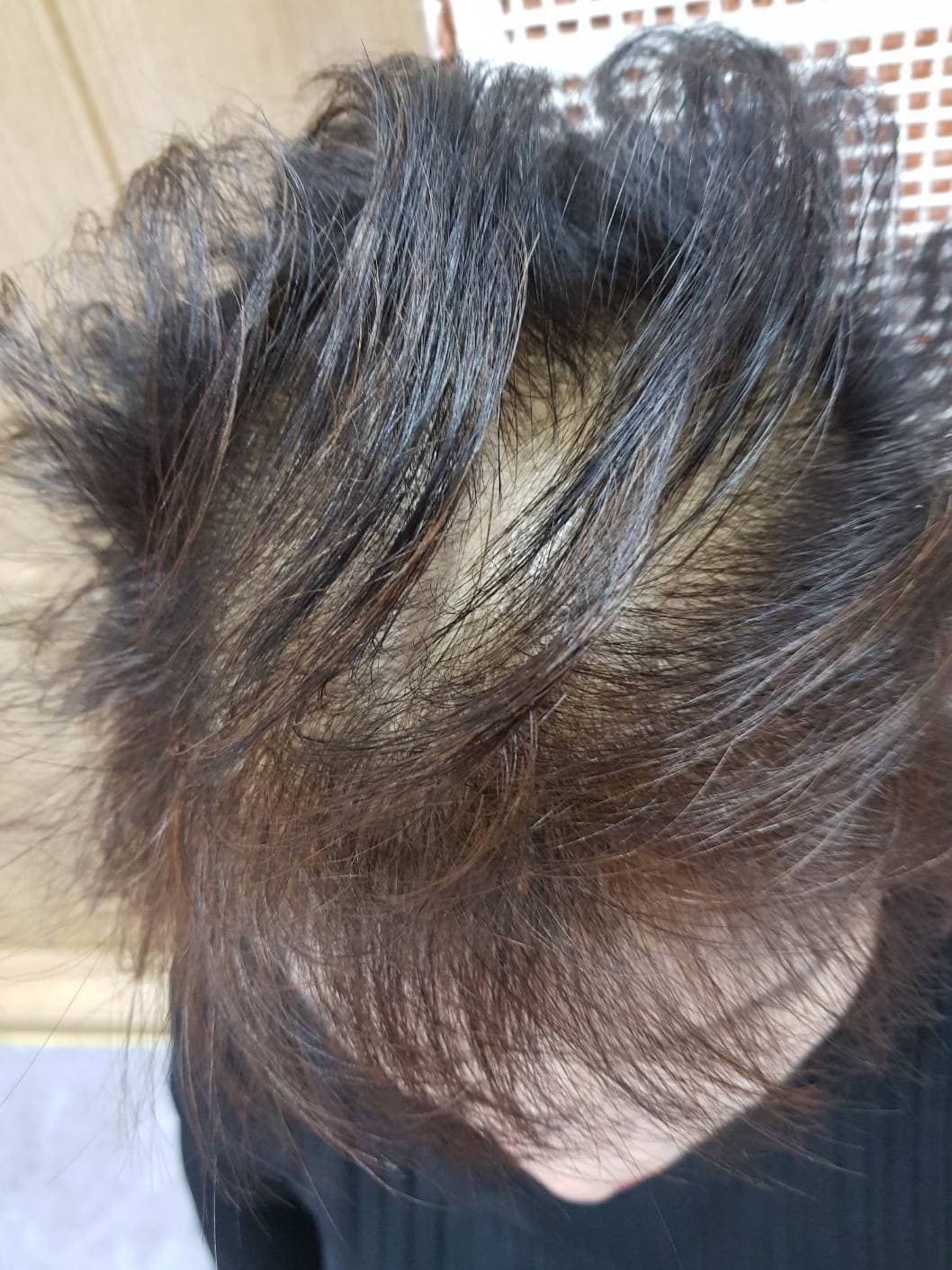 薄毛改善（女性） 施術前